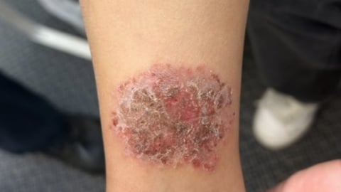 Rash on leg