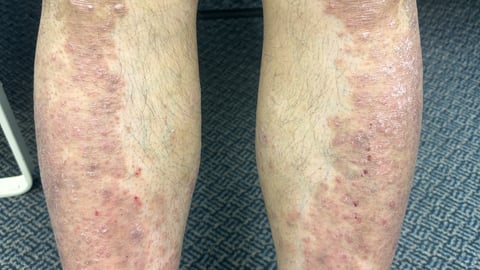 Rash on leg