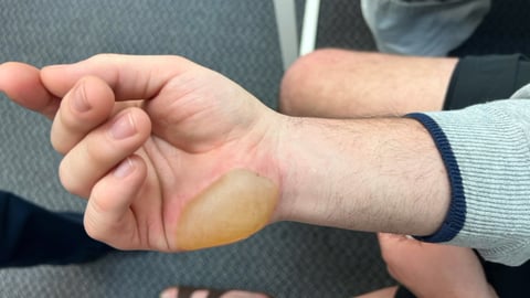 Blister