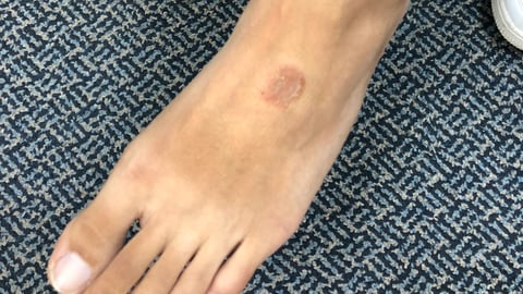 Close up of foot with small circular rash