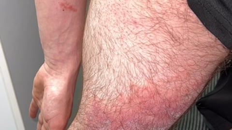 Rash