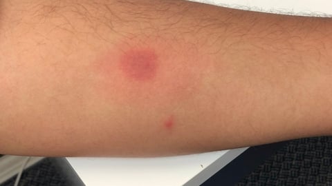 Dot on skin.