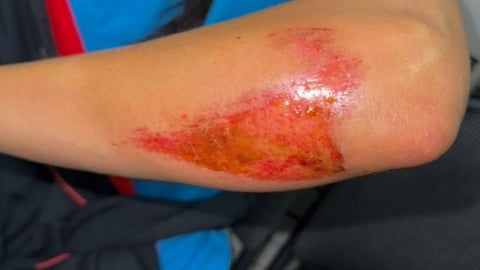 Close up of a man's arm with a large red rash indicating a possible infection