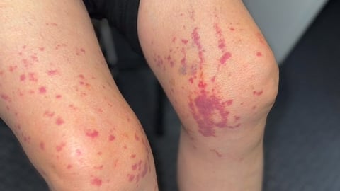 Woman's legs with large red splotches indicating a dermatological issue