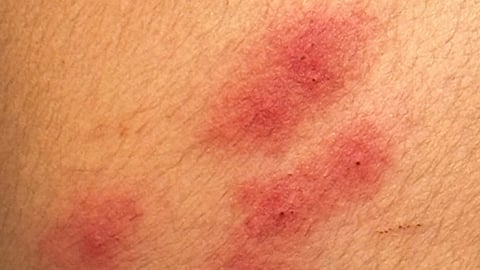 Close up of red welts on white skin
