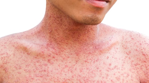 Front view of a man with a problem skin rash; Shutterstock ID 697281589