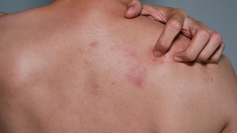 Close up view of man scratching  his back .Painful back skin rash with blisters in a limited area.A man who having varicella blister , , , chickenpox,Herpes zoster or Shingles.; Shutterstock ID 1901227429