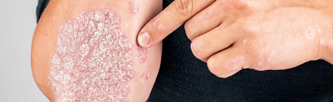 plaque psoriasis