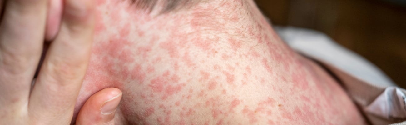 Young fair-skinned boy with red measles rash on his neck