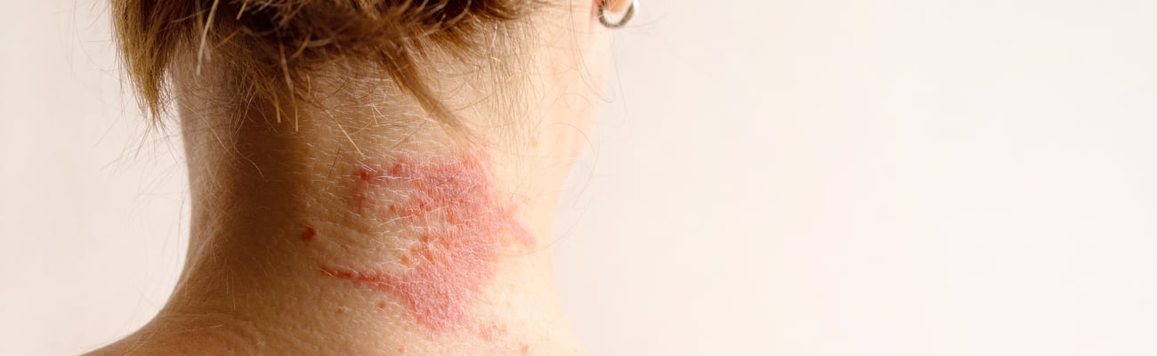 Manifestation of atopic dermatitis as a red itchy spot on a woman’s neck
