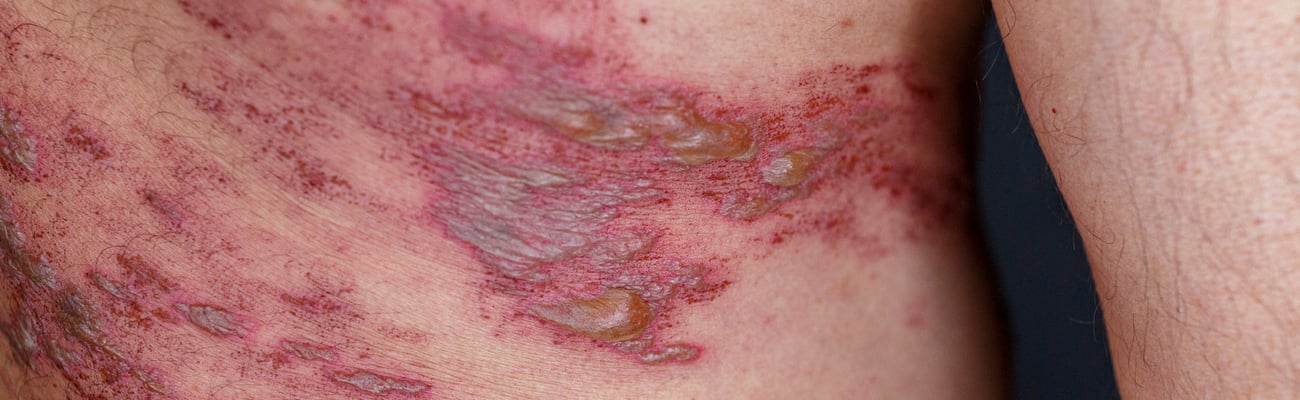 Close up a rash from herpes zoster infection