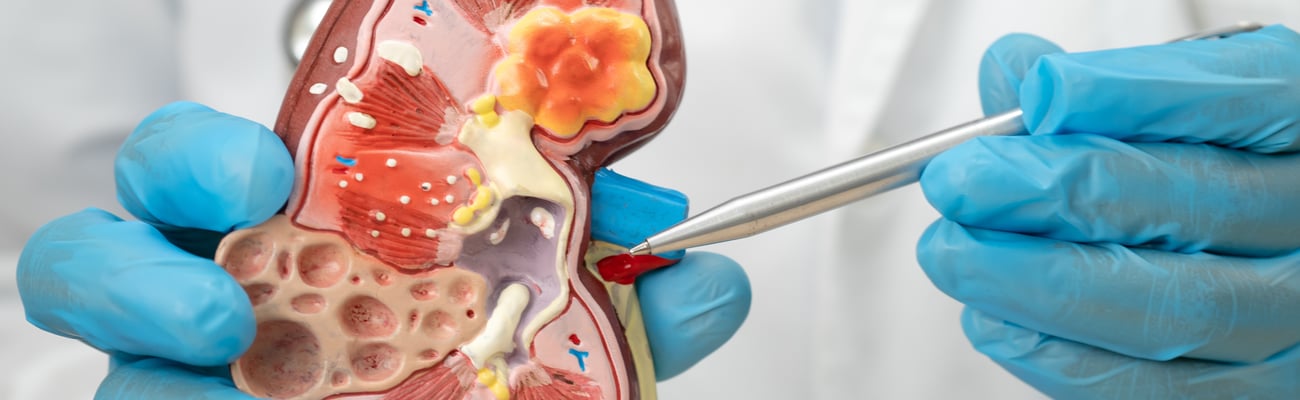 Blue-gloved doctor hands demonstrating a model of a kidney