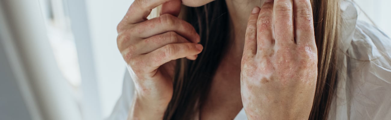 Young woman with rough skin from eczema on her hands