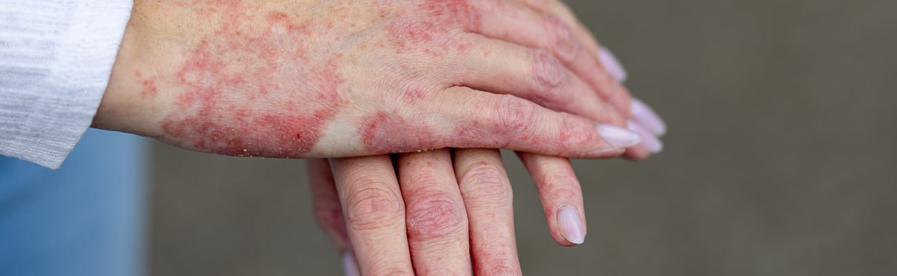 Young fair-skinned with woman with pained nails with her hands covered in painful-looking psoriasis