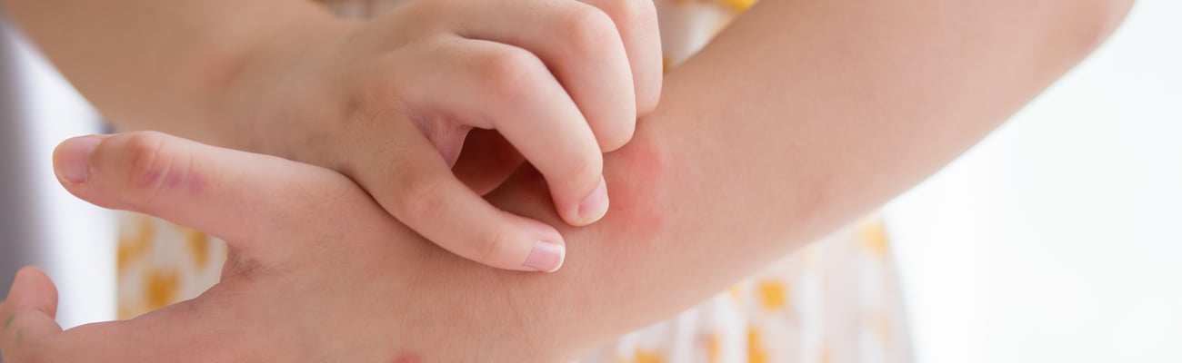 Close up of young fair-skinned girl with a rash on her arm
