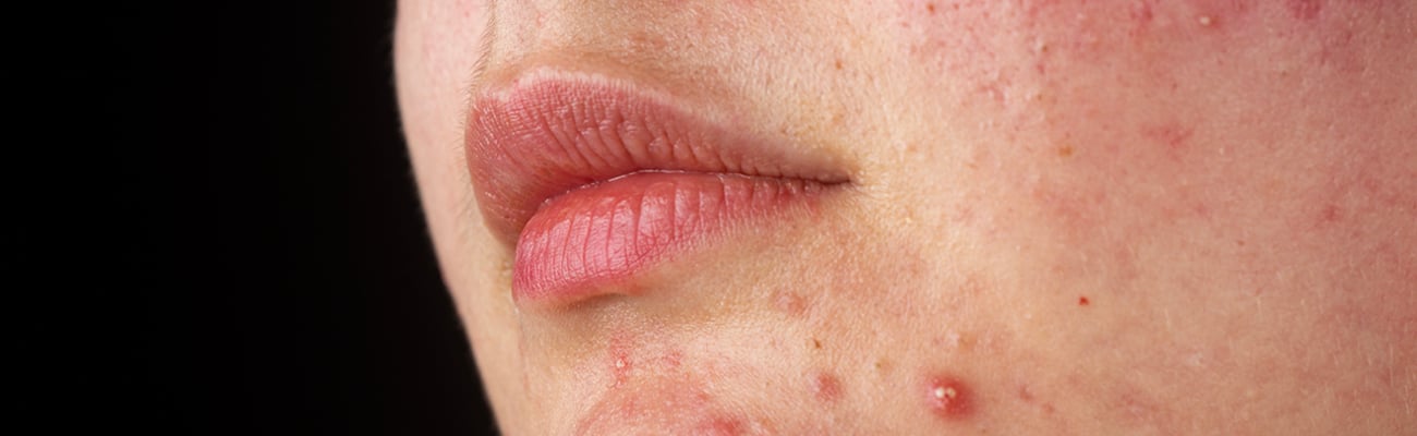 A young white woman's chin covered in acne
