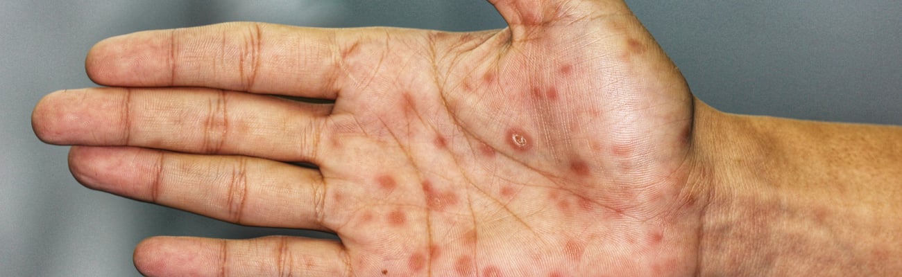 Close up of a patient's hand with syphilitic sores