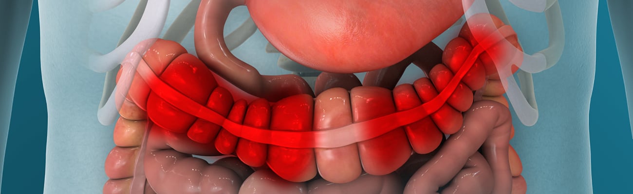Cartoon rendering of inflamed large intestines
