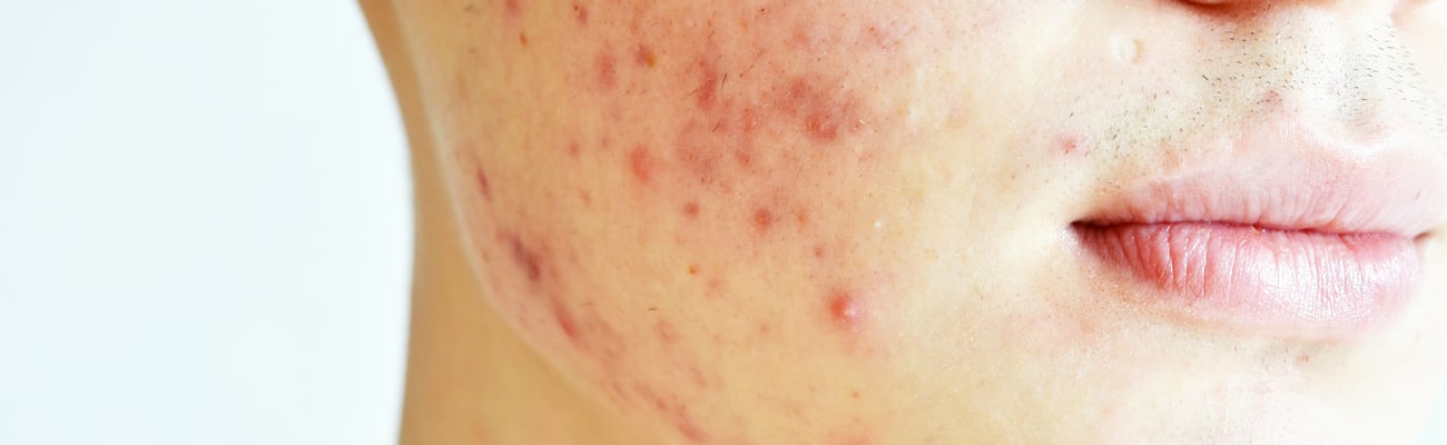 Close up of face with acne