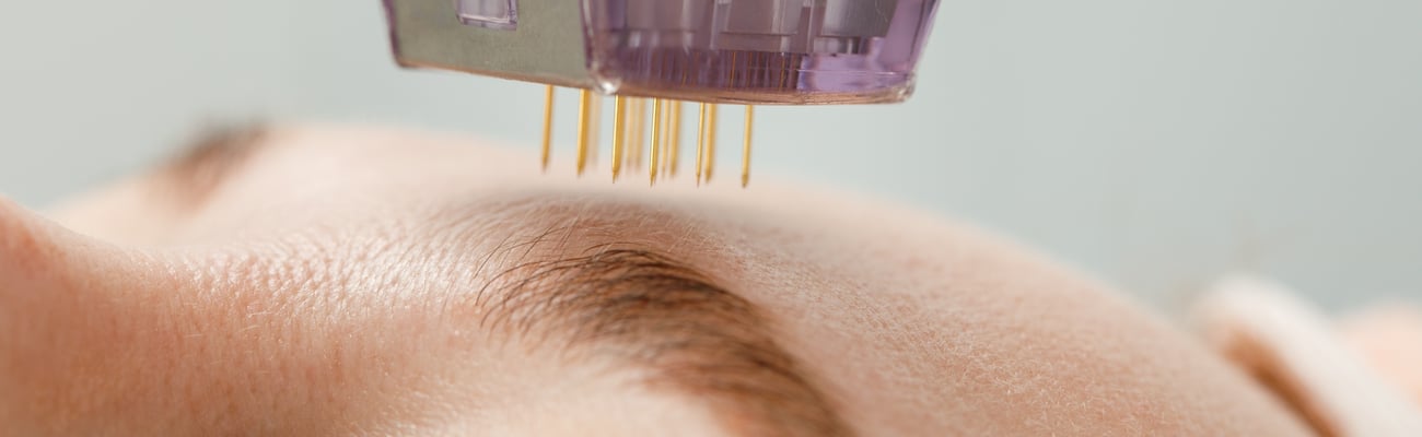 Microneedle mesotherapy. Woman receiving micro needling rejuvenation treatment in a cosmetology clinic.