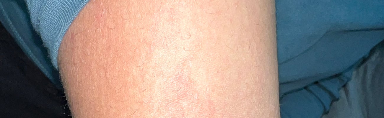Rash area
