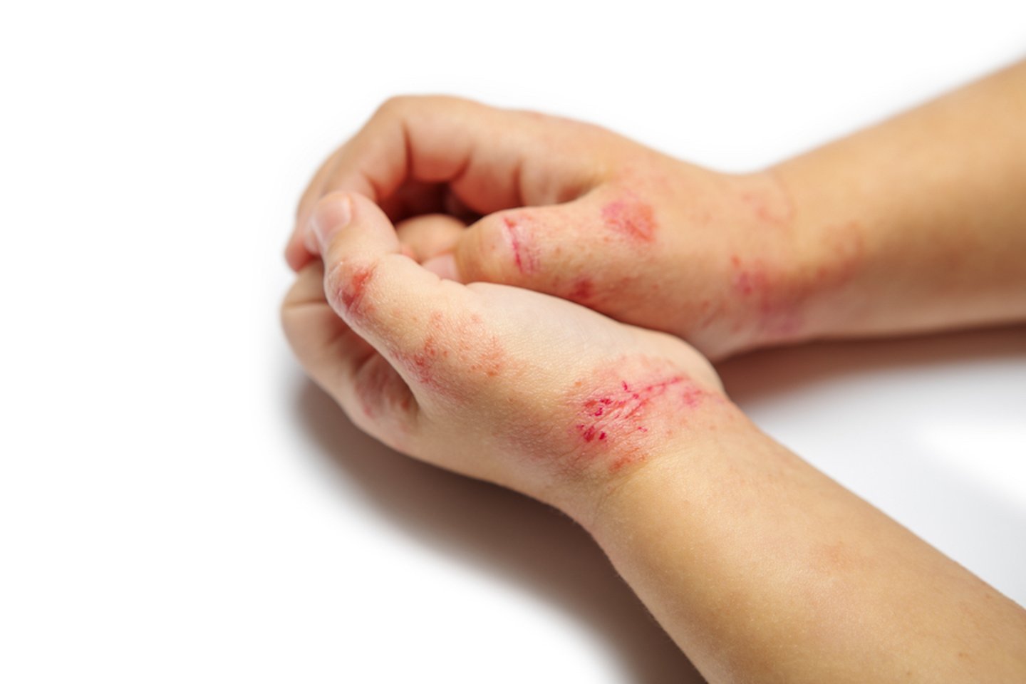 A photo of light-skinned child's hands with atopic dermatitis