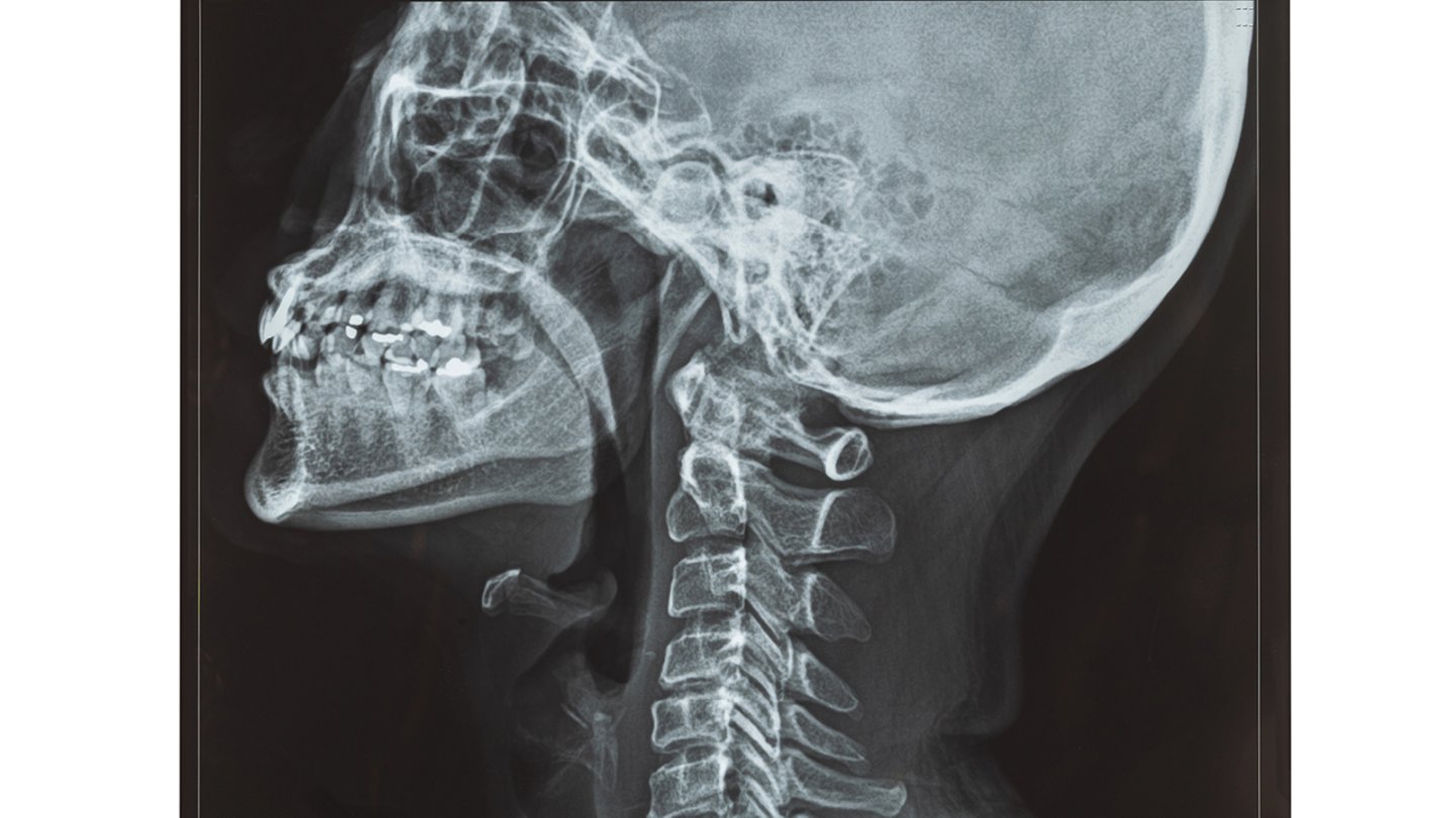 X-ray of a person's head and neck bones