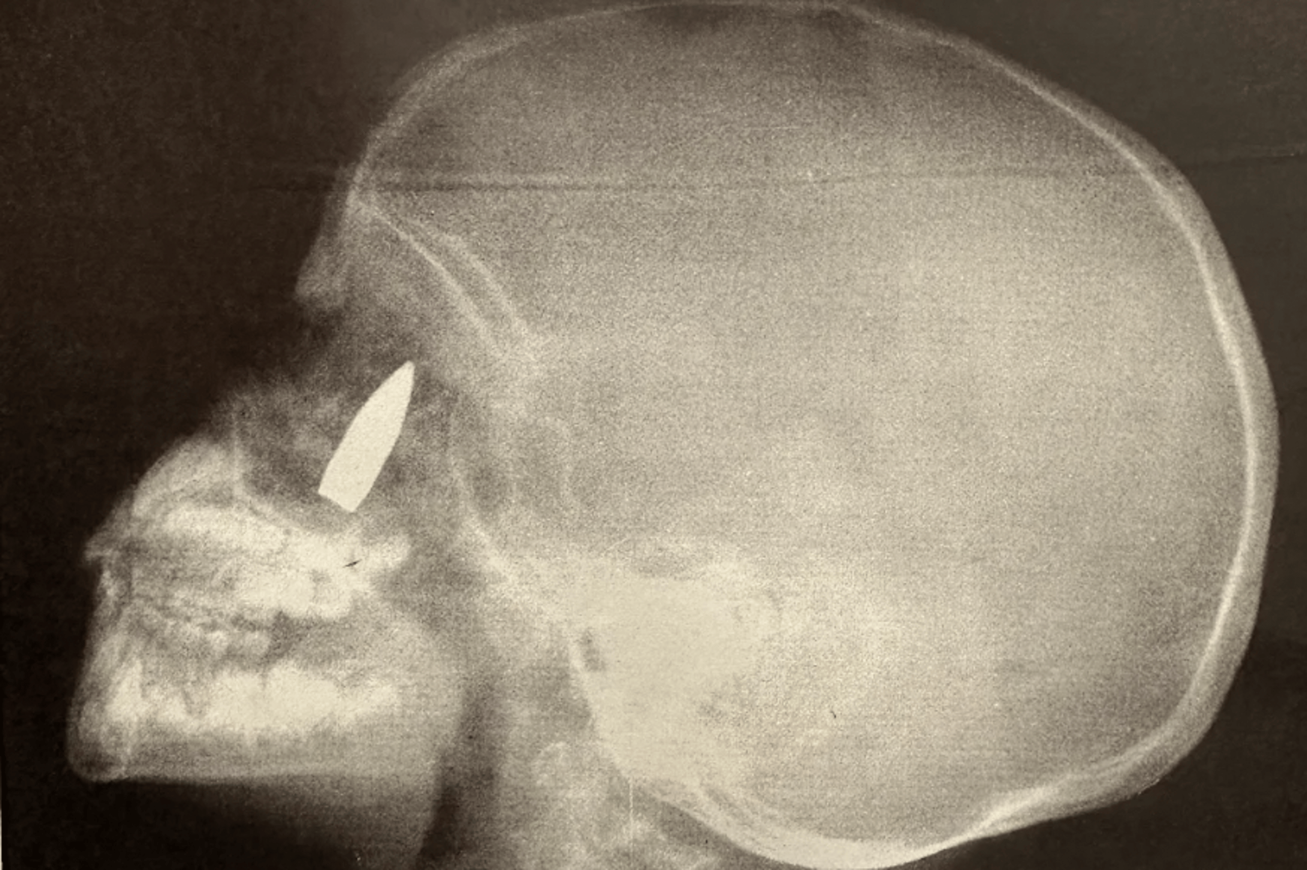 X-ray showing a bullet lodged in a patient's head