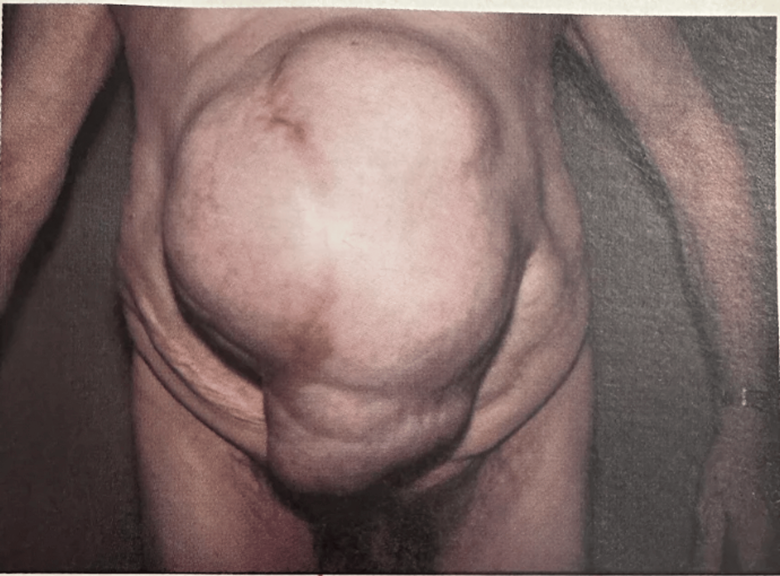 An enormous hernia in a patient's stomach area