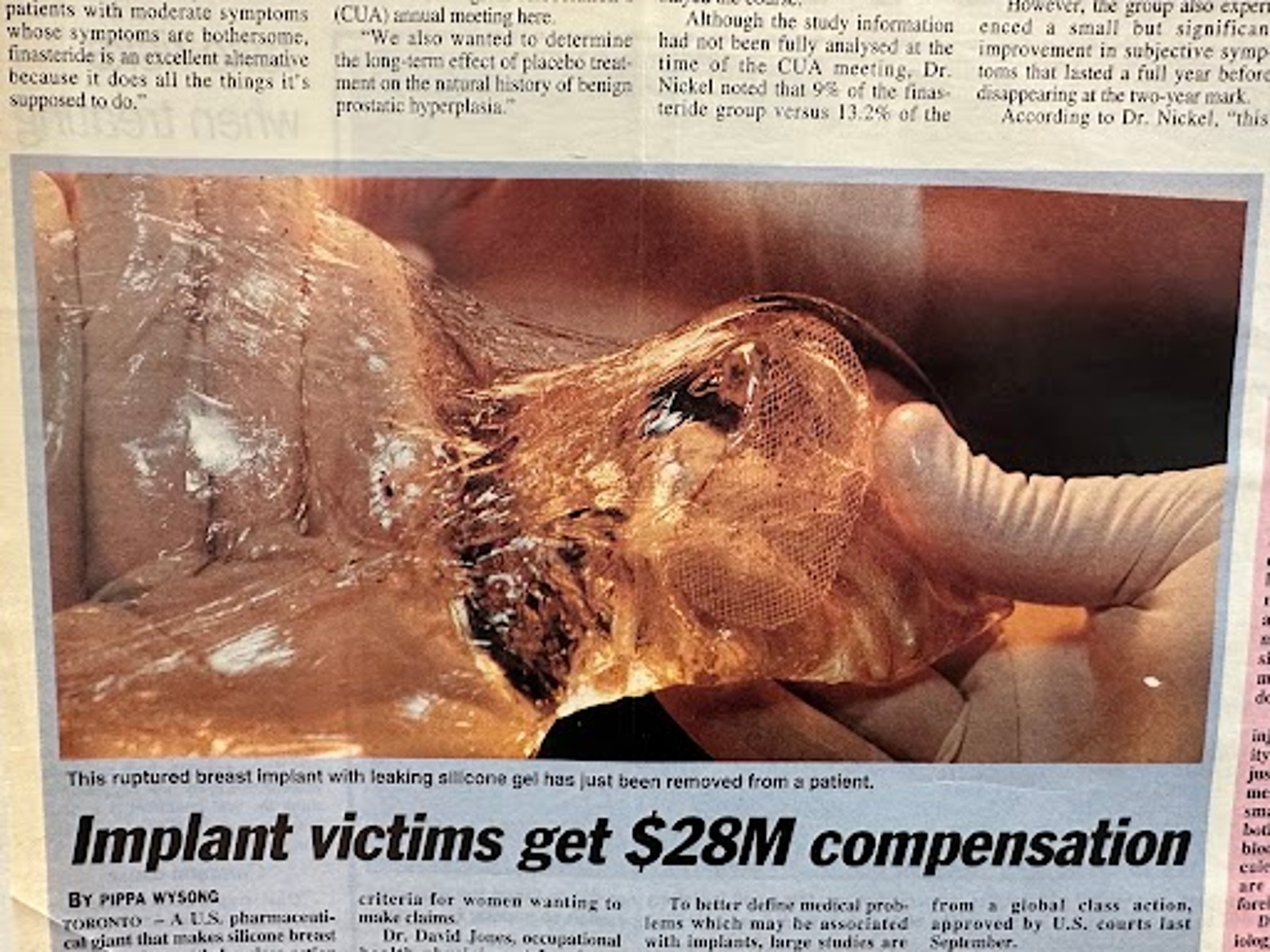 Breast implant after rupturing