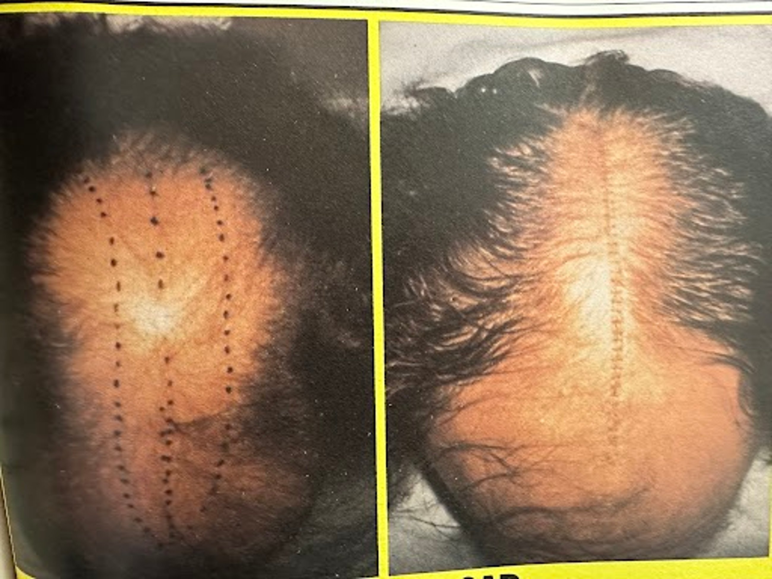 Before and after photos of scalp reduction surgery